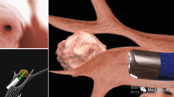 盤點(diǎn)4款獲批的經(jīng)自然腔道手術(shù)機(jī)器人