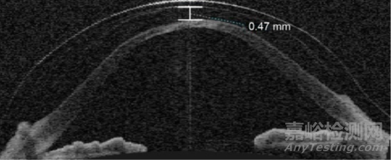 現(xiàn)代鞏膜鏡的設計特點及臨床應用
