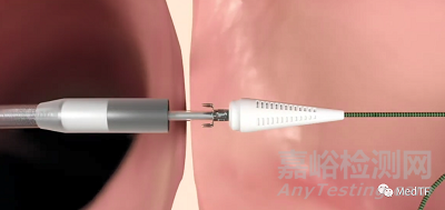 Alleviant System:無植入物的心房分流
