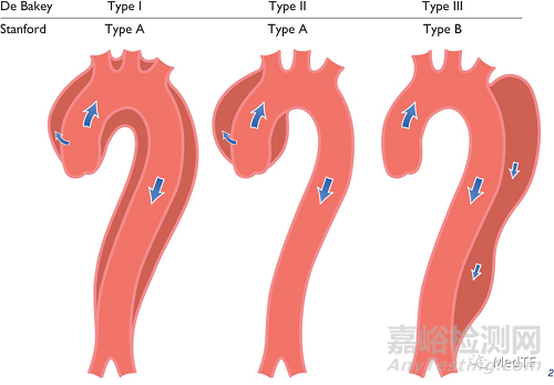Allay:密網(wǎng)支架用于主動(dòng)脈夾層置換
