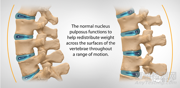 全球唯一！腰椎髓核置換系統(tǒng)開展臨床試驗