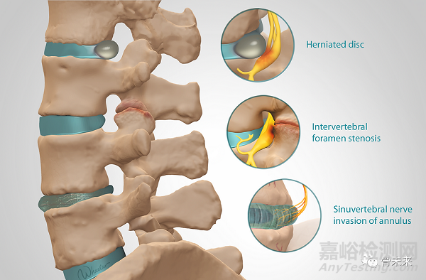 全球唯一！腰椎髓核置換系統(tǒng)開展臨床試驗