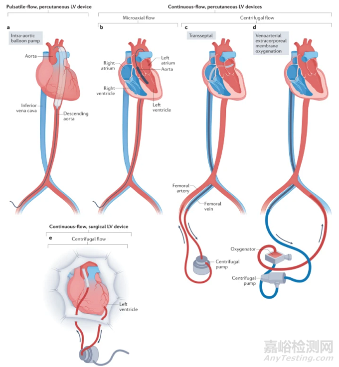 機(jī)械循環(huán)輔助裝置進(jìn)展及應(yīng)用