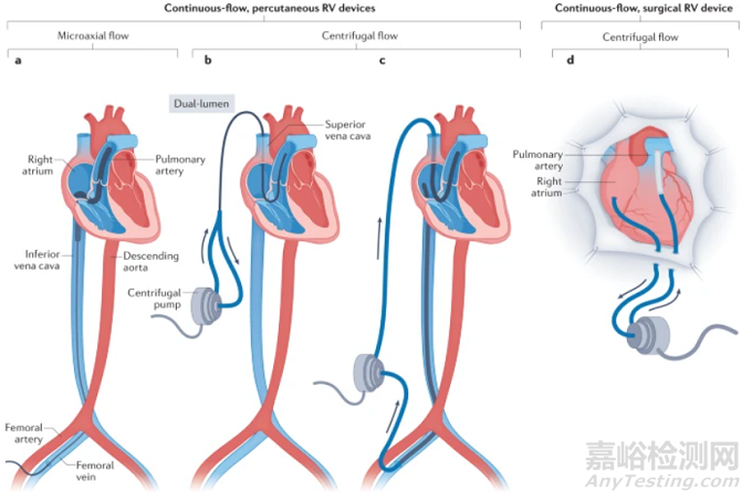 機(jī)械循環(huán)輔助裝置進(jìn)展及應(yīng)用