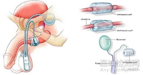 UroActive:智能化人工尿道括約肌