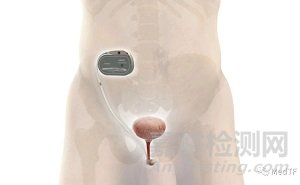 UroActive:智能化人工尿道括約肌