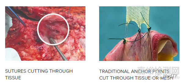 T-Line Hernia Mesh：具有縫合功能的疝氣補片
