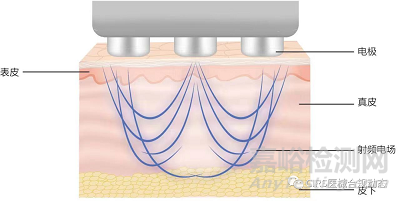 射頻美容儀臨床試驗(yàn)設(shè)計(jì)思路
