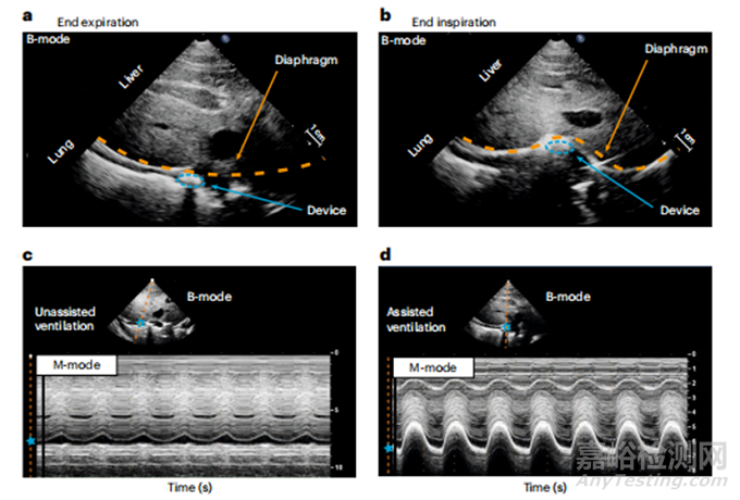 一種利用植入式軟體機器人改善呼吸功能不全的方法
