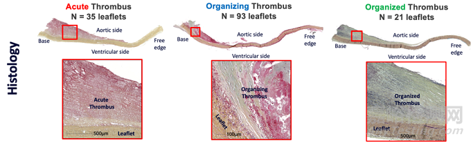 2022年結(jié)構(gòu)性心臟病醫(yī)療器械年度盤點(diǎn)