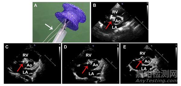 2022年結(jié)構(gòu)性心臟病醫(yī)療器械年度盤點(diǎn)