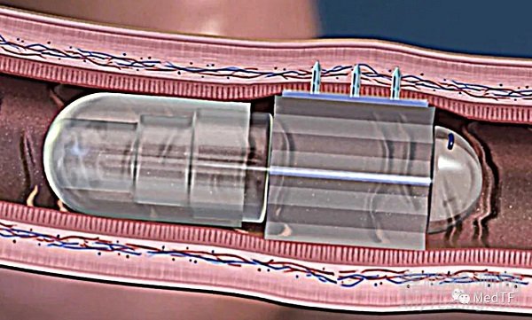 PillBot:具有推進系統(tǒng)的膠囊內鏡