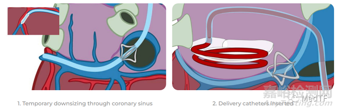 CathHELIX：經(jīng)導(dǎo)管螺旋支架修復(fù)二尖瓣