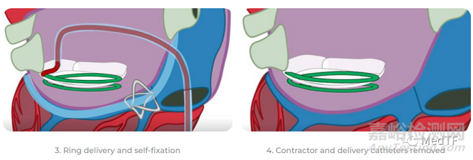 CathHELIX：經(jīng)導(dǎo)管螺旋支架修復(fù)二尖瓣