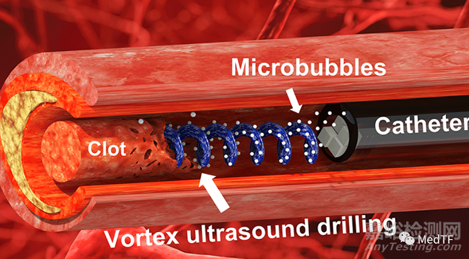 “渦流超聲”:快速分解大腦中的血栓