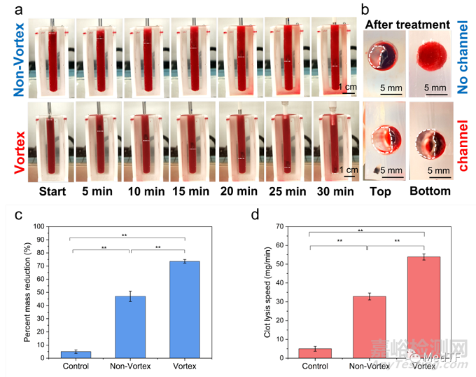 “渦流超聲”:快速分解大腦中的血栓