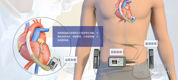 Syntach：具備修復(fù)二尖瓣反流的左心室輔助|恢復(fù)左心室自然泵血