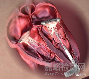 Syntach：具備修復(fù)二尖瓣反流的左心室輔助|恢復(fù)左心室自然泵血