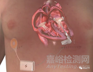 Syntach：具備修復(fù)二尖瓣反流的左心室輔助|恢復(fù)左心室自然泵血