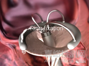 Syntach：具備修復(fù)二尖瓣反流的左心室輔助|恢復(fù)左心室自然泵血