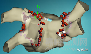 雅培首款柔性頭端的接觸壓力導(dǎo)管TactiFlex獲得CE批準(zhǔn)上市