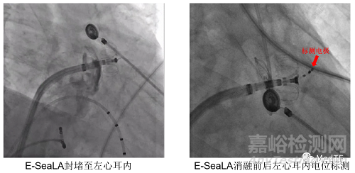 E-SeaLA：全球首創(chuàng)具有PFA消融功能的左心耳封堵器