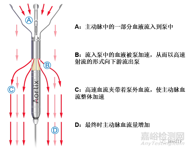 Aortix: 研究顯示介入泵能夠快速緩解充血