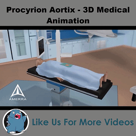 Aortix: 研究顯示介入泵能夠快速緩解充血