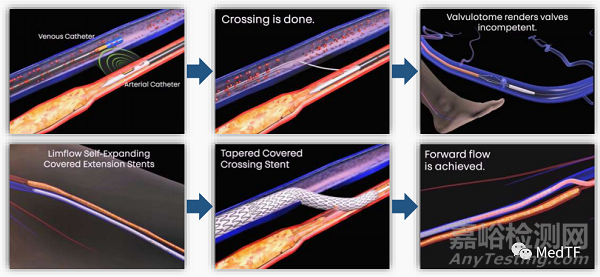 LimFlow System:使76%的無治療選擇“CLTI”患者避免截肢