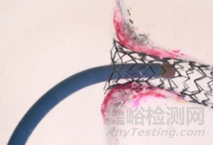 FLASH:冠脈開口病變的雙球囊技術(shù)