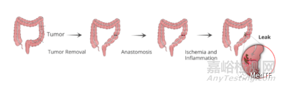 xBar：可吸收胃腸吻合口漏實時監(jiān)測設(shè)備