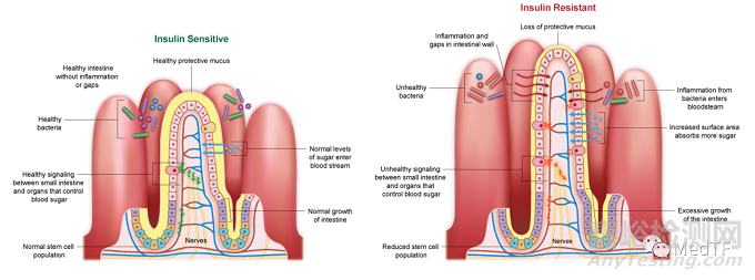 ReCET：電脈沖消融治療糖尿病