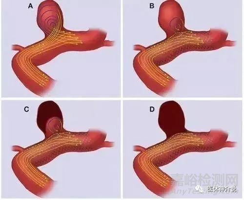 血流導(dǎo)向裝置的機(jī)制、特性和常見(jiàn)產(chǎn)品