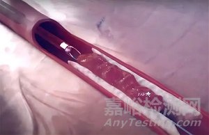 智能抽吸算法和導管如何加速血栓清除？