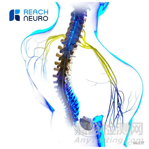 Avantis：脊髓刺激器恢復(fù)中風(fēng)患者上肢運動