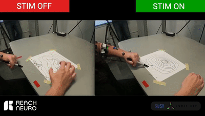 Avantis：脊髓刺激器恢復(fù)中風(fēng)患者上肢運動