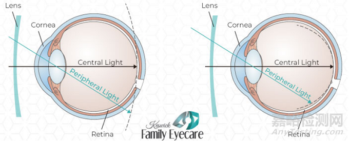 延緩近視眼鏡片獲FDA突破性設(shè)備認定