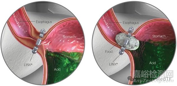 強(qiáng)生胃反流治療磁珠獲批FDA