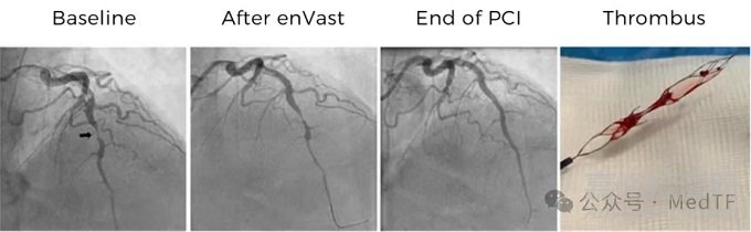 全球唯一冠脈取栓支架