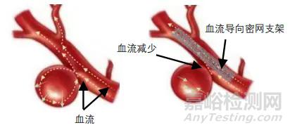國(guó)產(chǎn)首款新型涂層血流導(dǎo)向密網(wǎng)支架技術(shù)解析