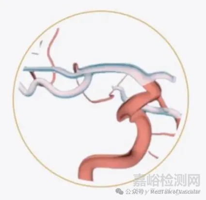 國(guó)產(chǎn)首款新型涂層血流導(dǎo)向密網(wǎng)支架技術(shù)解析