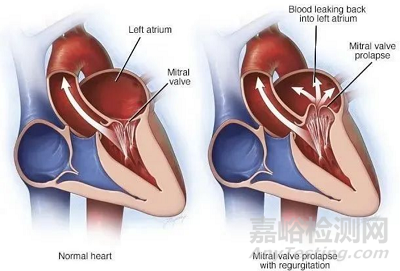 全球首款全尺寸規(guī)格型號和全彈片自鎖二尖瓣夾技術與市場解析