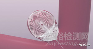 水母型的瘤內擾流裝置完成IDE臨床研究主要隊列入組