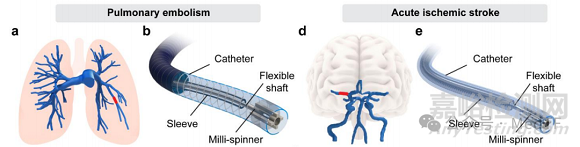 【創(chuàng)新醫(yī)械】Milli-Spinner:能將血栓體積縮小95%取栓神器,首過再通率超90%