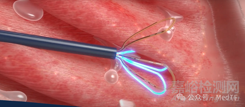 NEUROMARK：新型的慢性鼻炎消融導(dǎo)管獲批上市