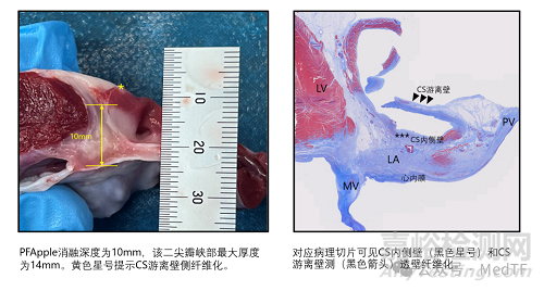全球首款球囊形大局灶PFA導(dǎo)管啟動多中心臨床