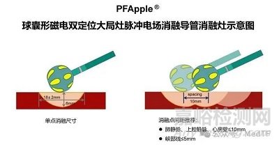 全球首款球囊形大局灶PFA導(dǎo)管啟動多中心臨床