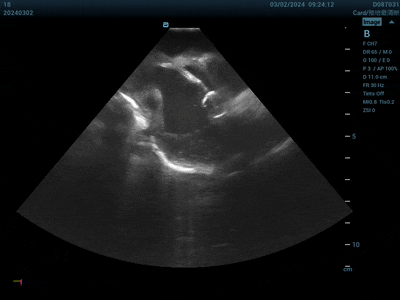 全球首款球囊形大局灶PFA導(dǎo)管啟動多中心臨床