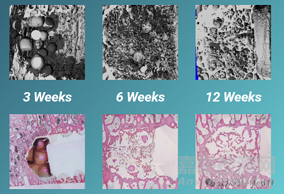 VCFix:首個可再生椎體增強產品 | 替代骨水泥