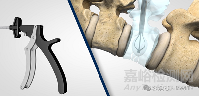 VCFix:首個可再生椎體增強產品 | 替代骨水泥